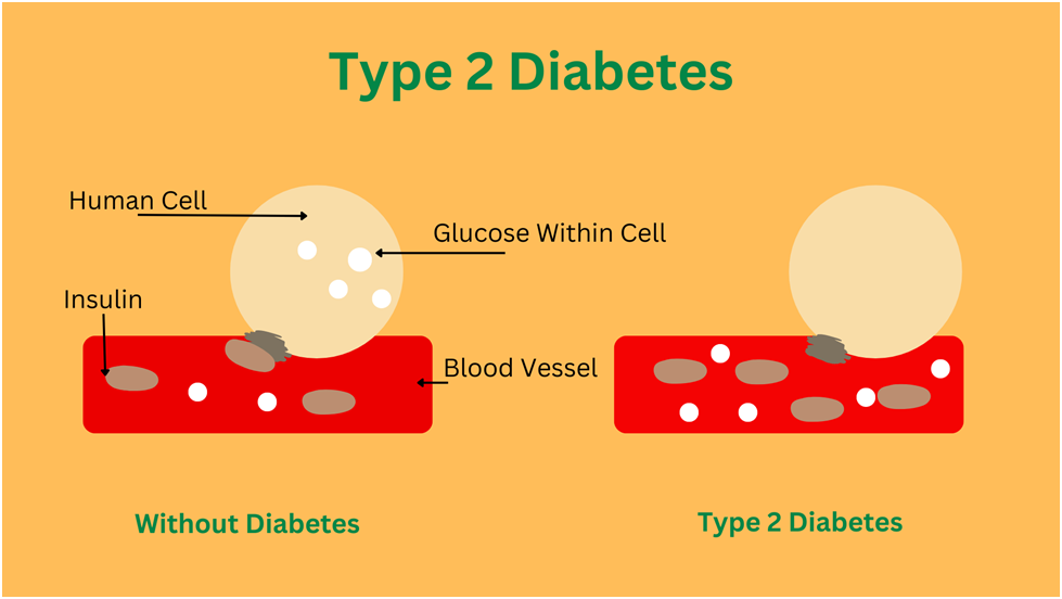 Type 2 diabetes