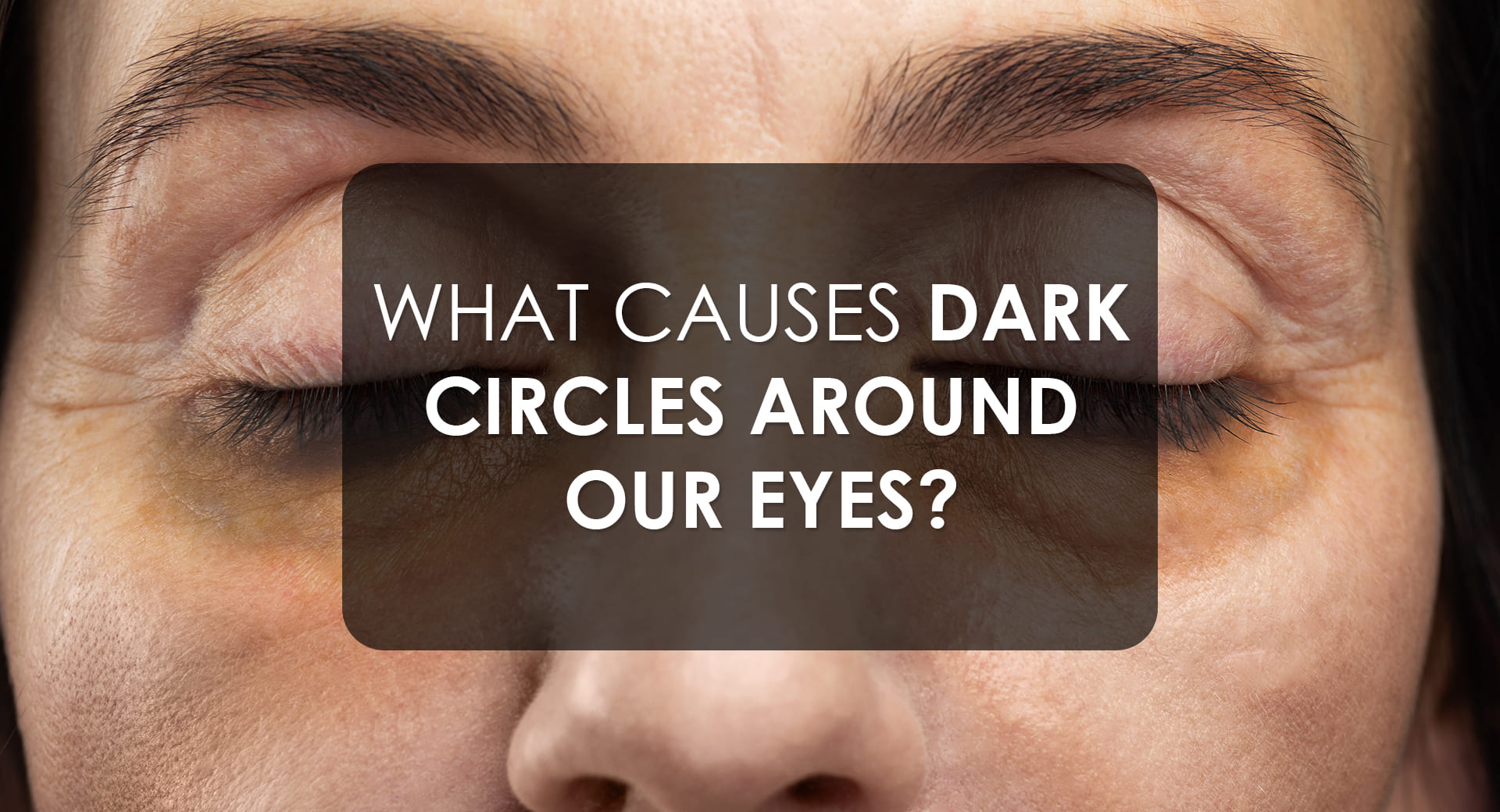 What Causes Dark Circles Around Your Eyes