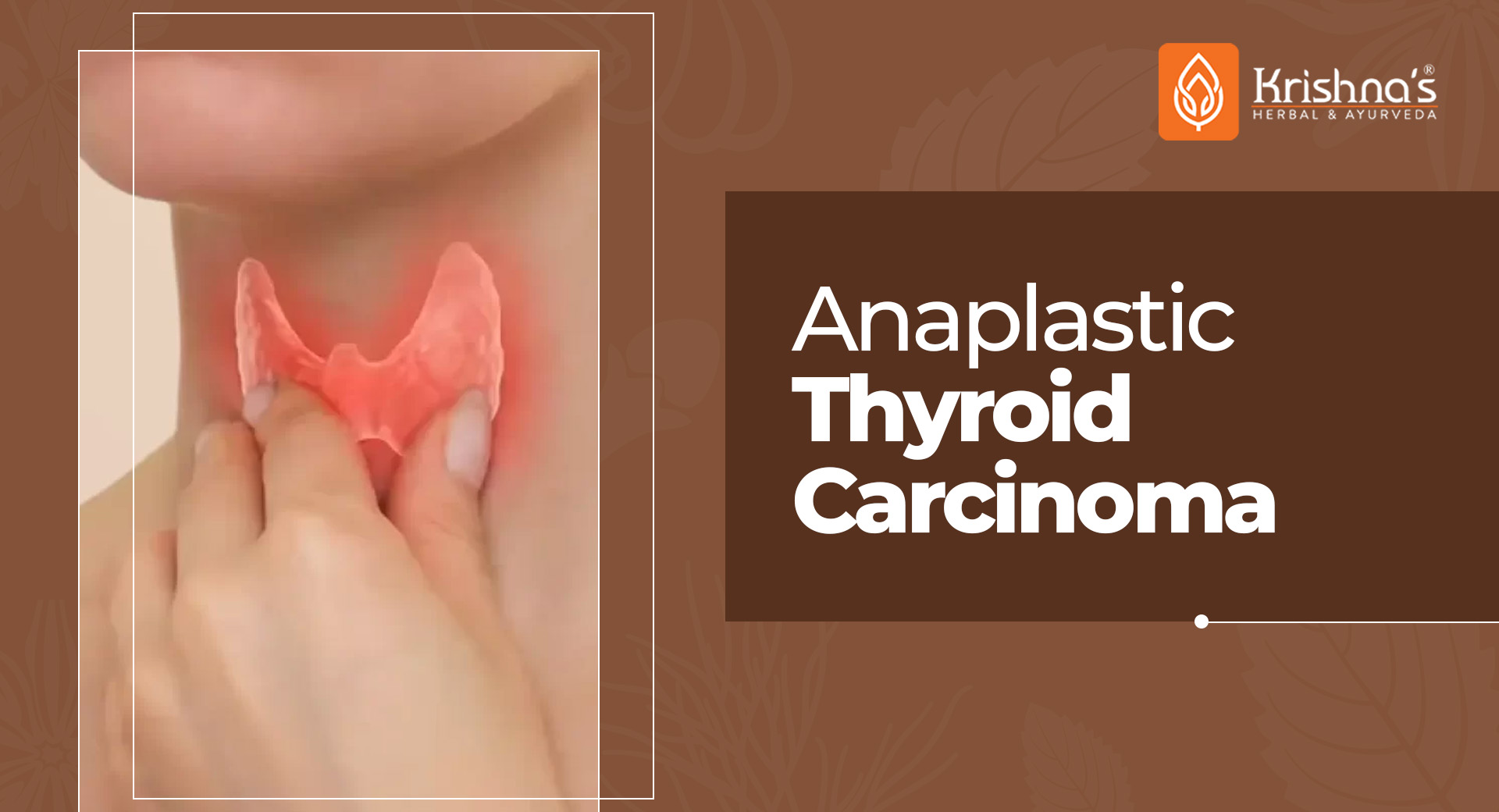 Anaplastic Thyroid Carcinoma
